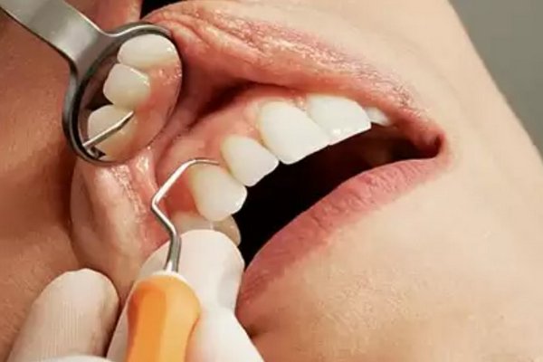 Жінка подала до суду на стоматолога за те, що він вилікував їй 28 зубів за п’ять годин