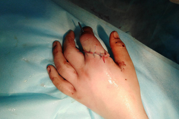 Закарпатські лікарі пришили чоловіку відрубаний палець