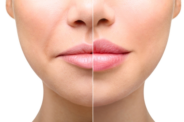 Контурная пластика губ: преимущества процедуры