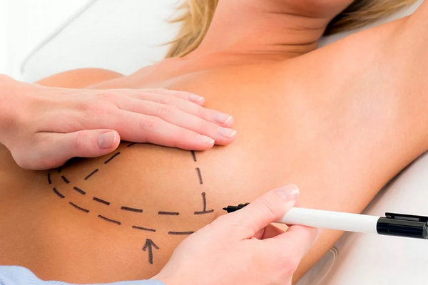 Что такое мастопексия? Цены на процедуру в Украине