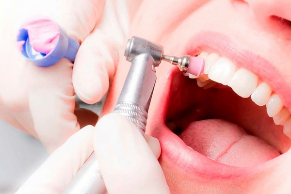 Навіщо потрібне полірування зубів?