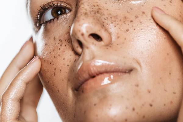 Профілактика пігментації та опіків — 4 правила, щоб захистити шкіру від сонця