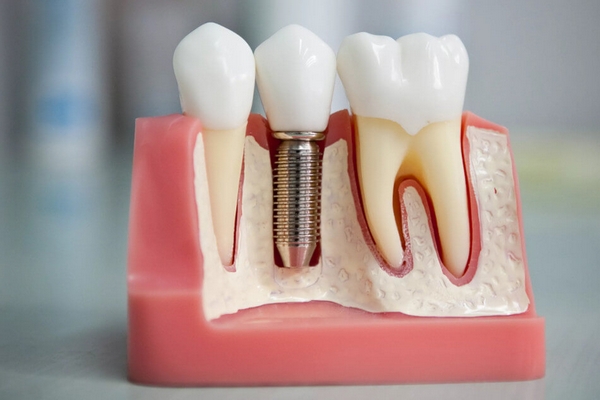 Когда нужна имплантация зубов?